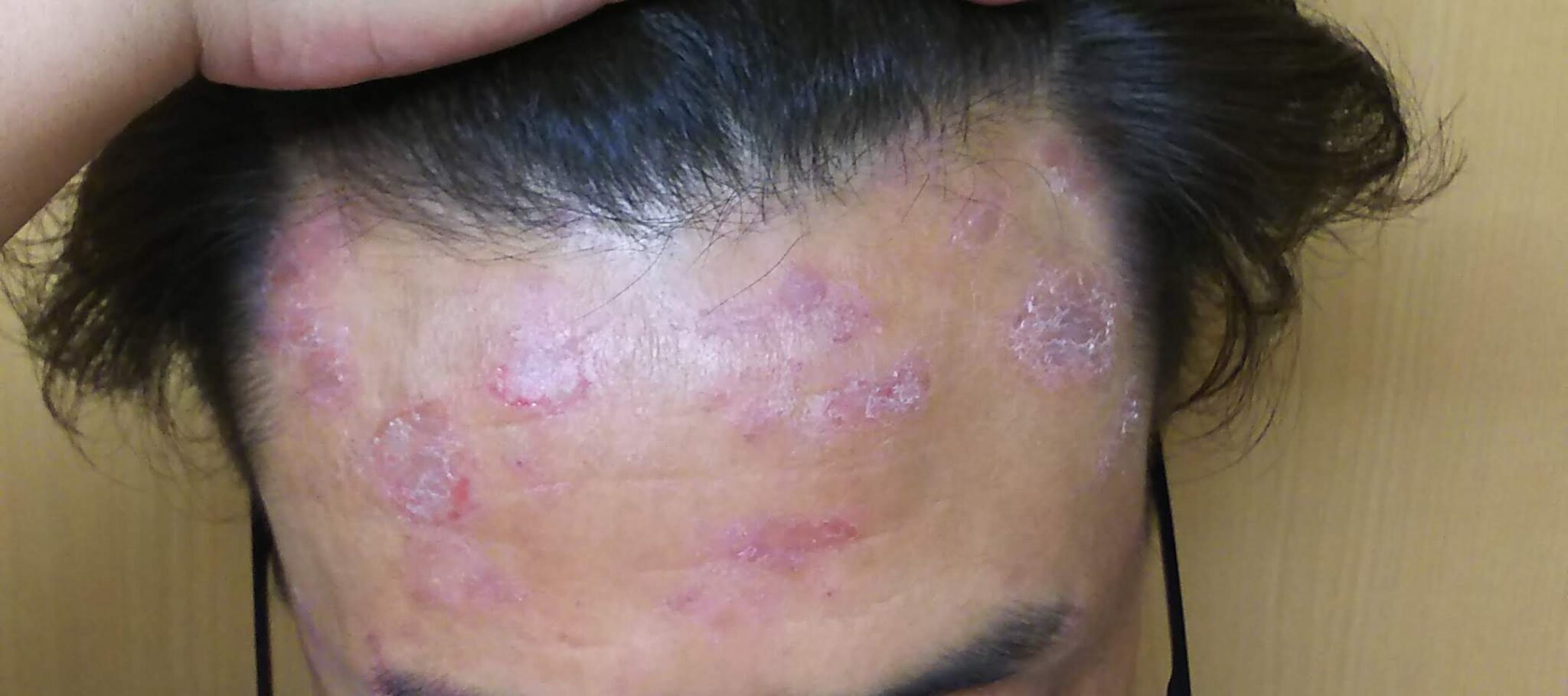 脂漏性皮膚炎のはじまり 脂漏性皮膚炎 経皮毒デトックス 脂漏性皮膚炎のはじまり 脂漏性皮膚炎 経皮毒デトックス
